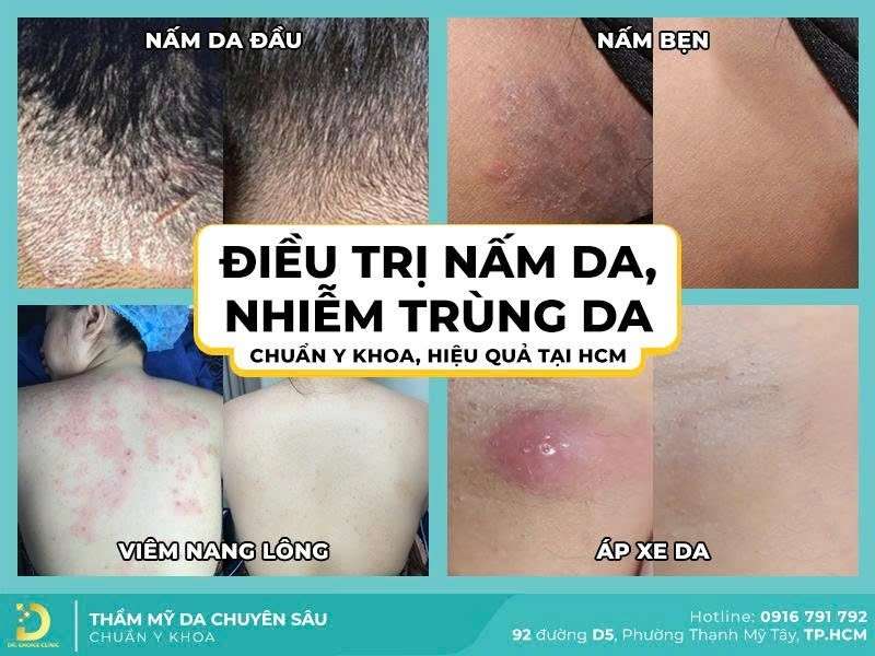 Quy trình điều trị nấm thân mình tại Dr. Choice Clinic 