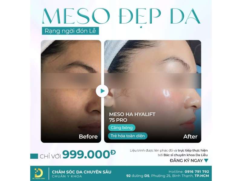 meso đẹp da rạng ngời đón lễ