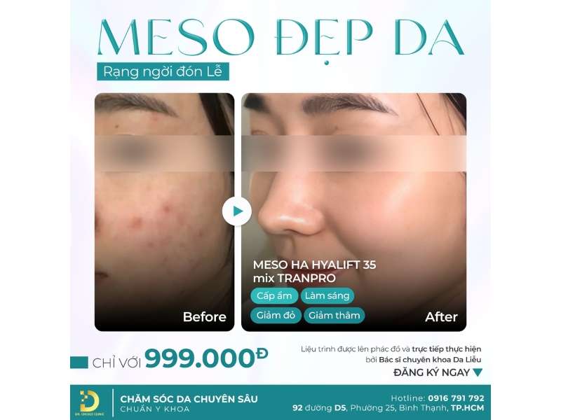 meso đẹp da