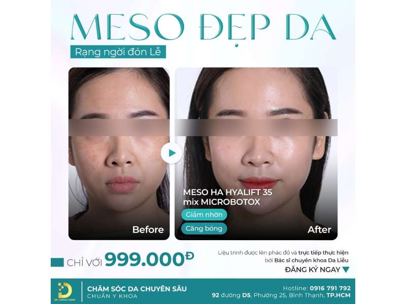 meso làm đẹp da đón lễ