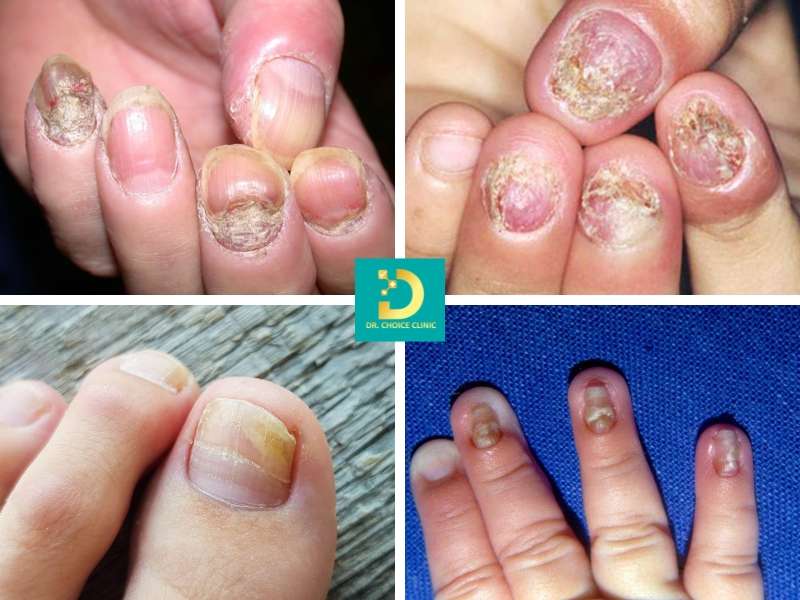 Nấm móng là gì? nguyên nhân hình thành do đâu?
