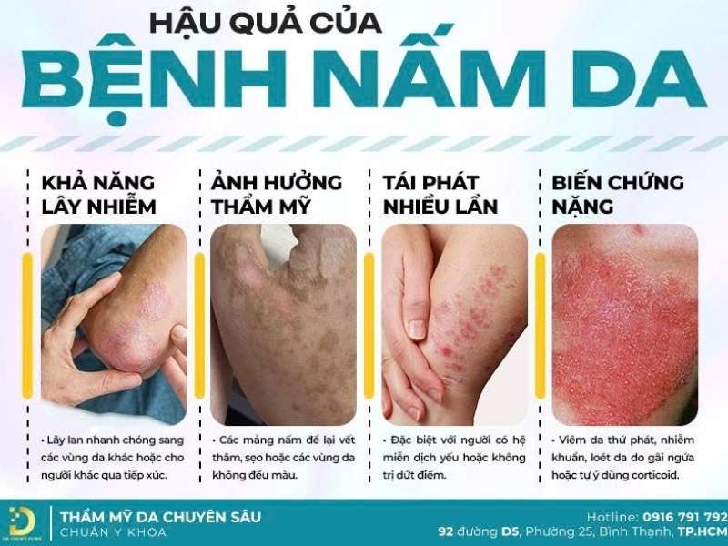 Nấm thân mình là gì? cách nhận biết chính xác