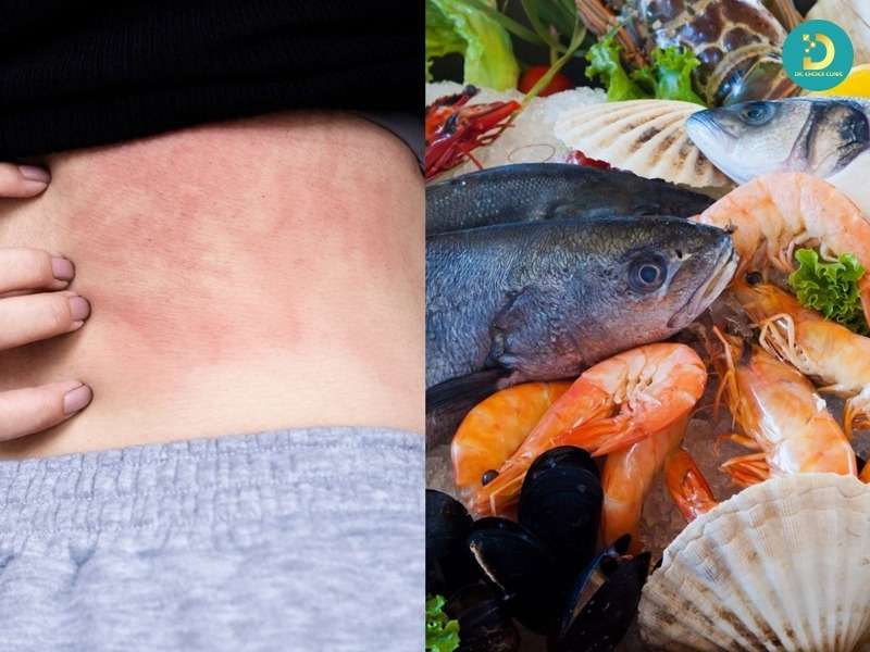Nguyên nhân gây mề đay thường gặp