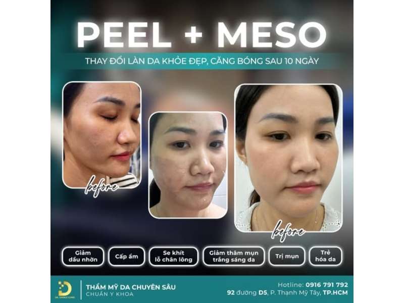 peel + meso thay đổi làn da khỏe đẹp