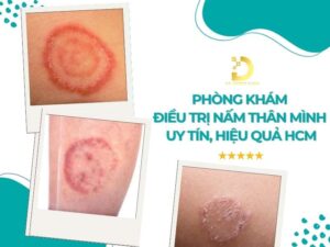 Phòng khám điều trị nấm thân mình uy tín