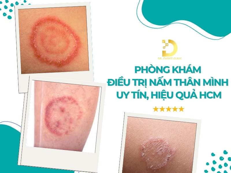 Phòng khám điều trị nấm thân mình uy tín