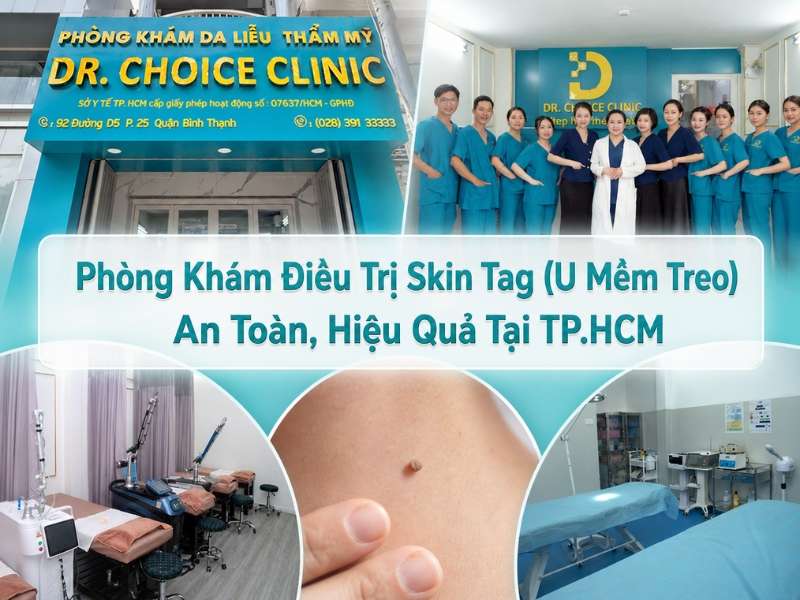 Phòng Khám Điều Trị Skin Tag (U Mềm Treo) An Toàn, Hiệu Quả Tại TP.HCM