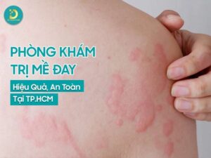 Phòng khám trị mề đay hiệu quả