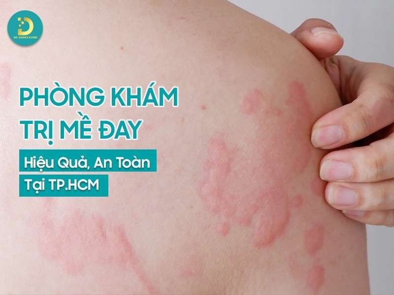 Phòng khám trị mề đay hiệu quả