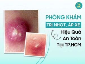 Phòng khám trị nhọt, áp xe hiệu quả