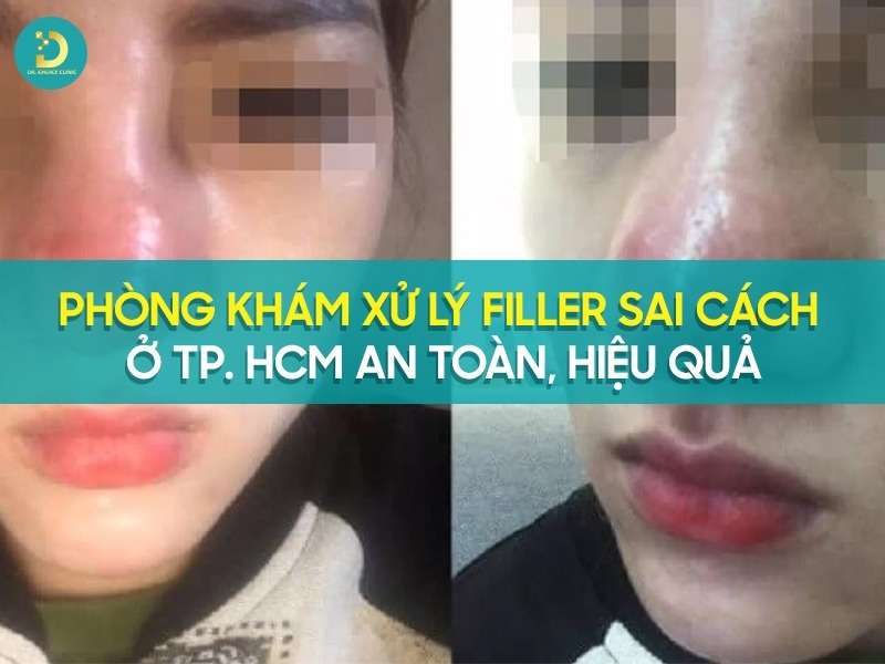 Phòng khám xử lý filler sai cách ở tp. HCM 