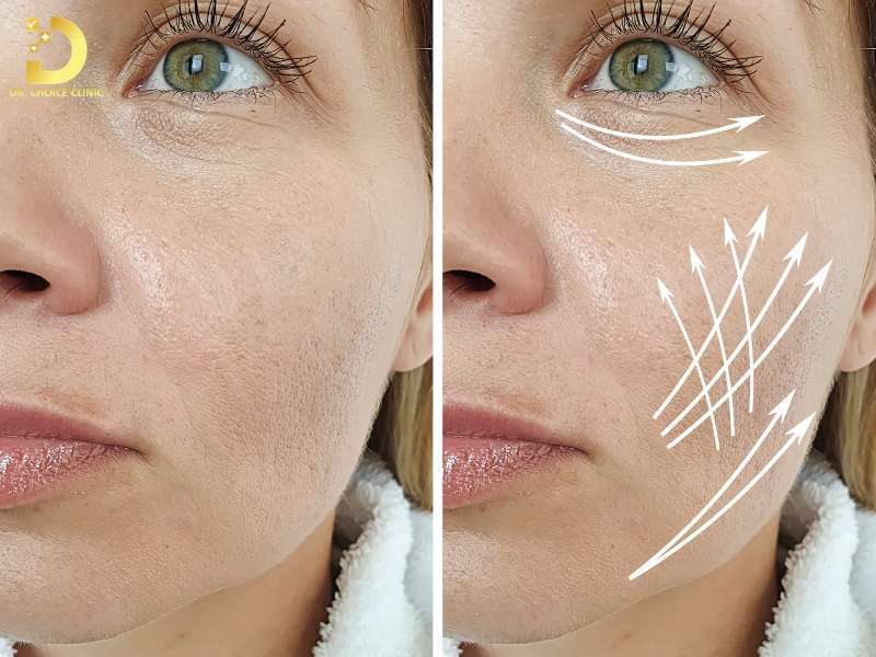 Tổng quan về nếp nhăn & rãnh sâu dưới góc độ da liễu
