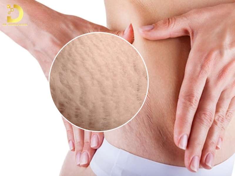 Tổng quan về sẹo rạn da