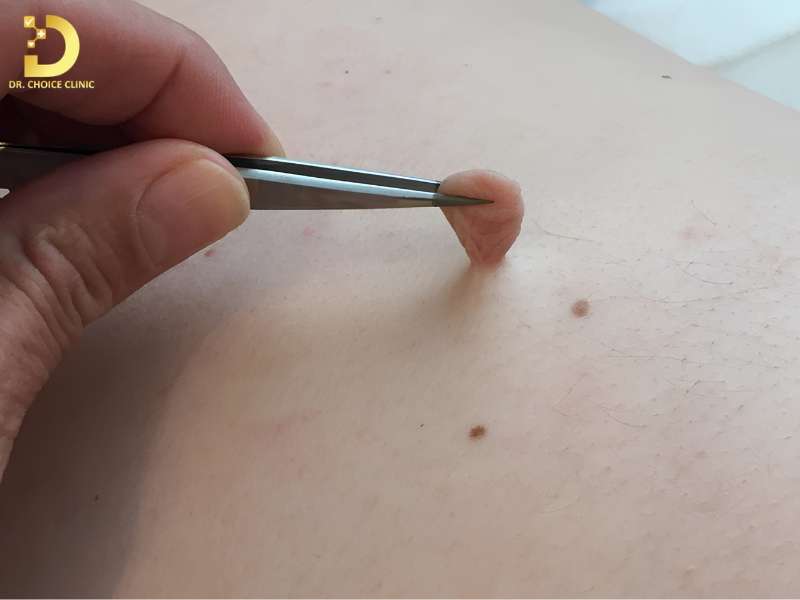 Vì sao skin tag không nên tự ý loại bỏ tại nhà?