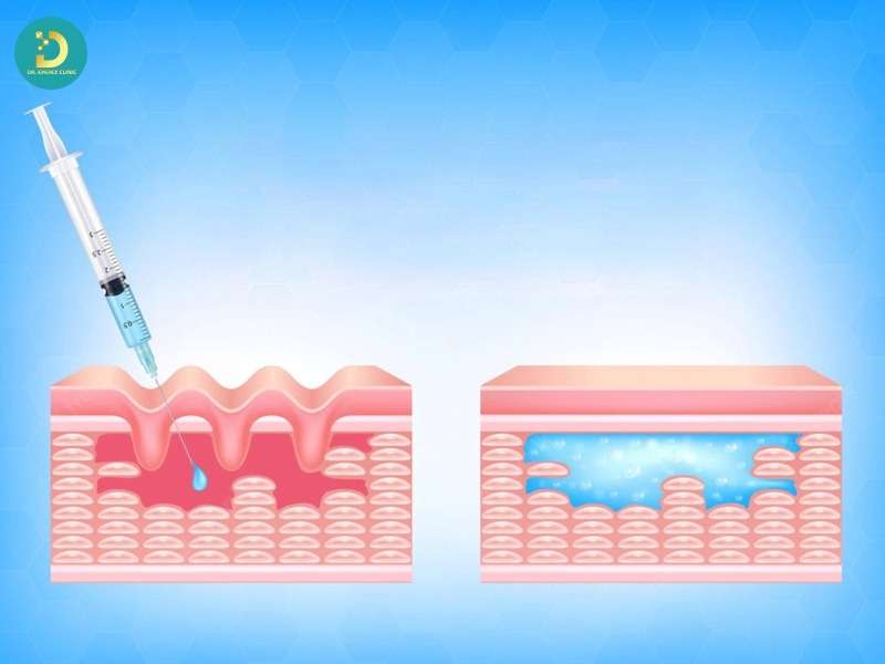 Xác định loại filler & vị trí (có thể dùng siêu âm)