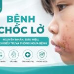 Bệnh chốc lở