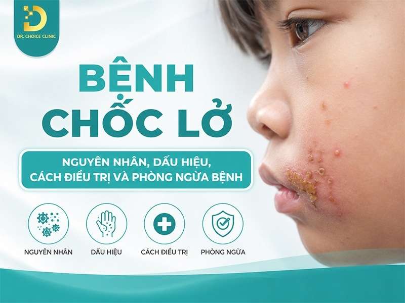 Bệnh chốc lở