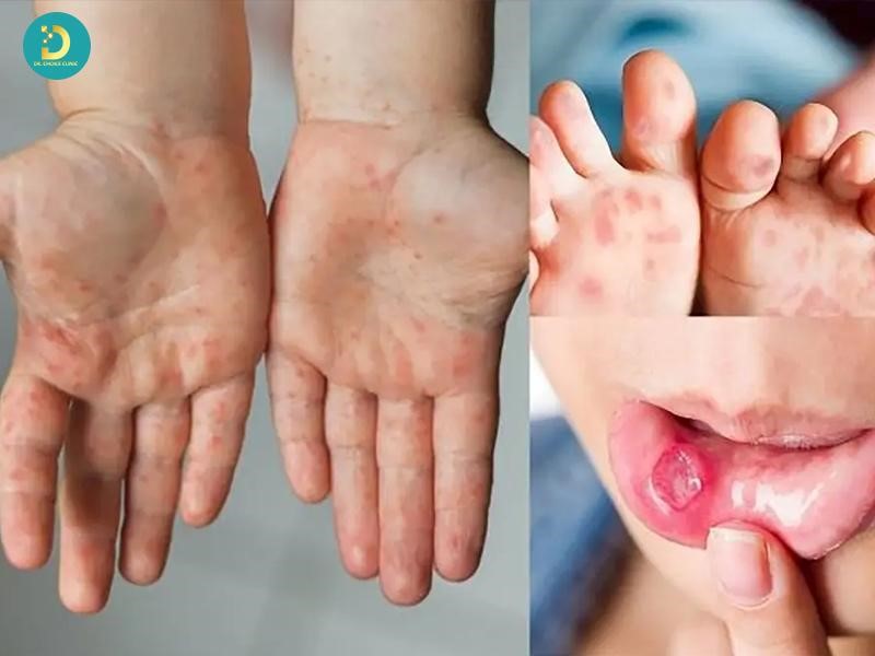 Các Bệnh Ngoài Da Ở Trẻ Em Thường Gặp Và Cách Xử Lý, Phòng Ngừa 17 Nhóm phát ban ngoài da do siêu vi ở trẻ em