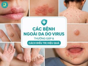 Tìm hiểu các bệnh ngoài da do virus