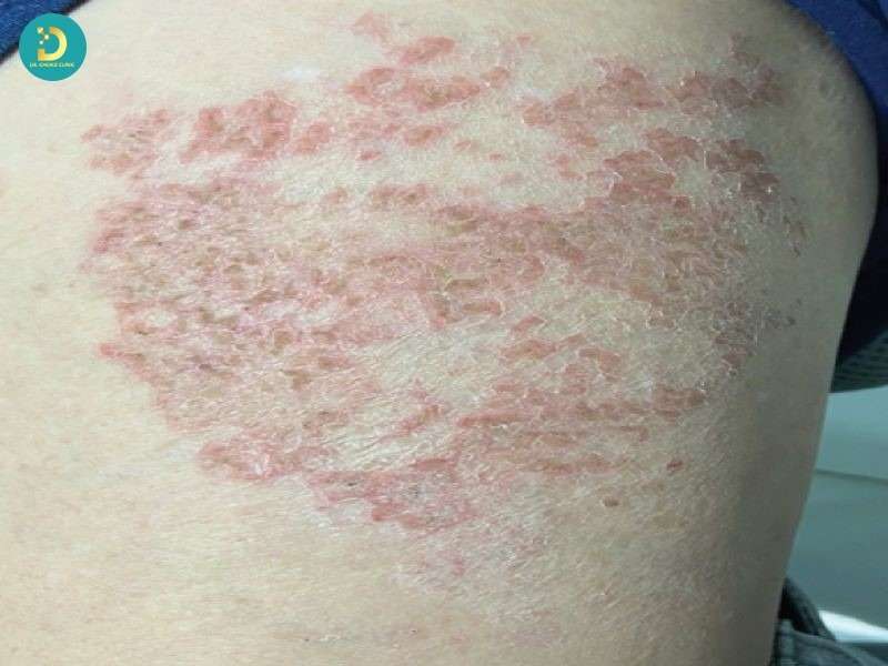 Bệnh nhiễm trùng da do ký sinh trùng