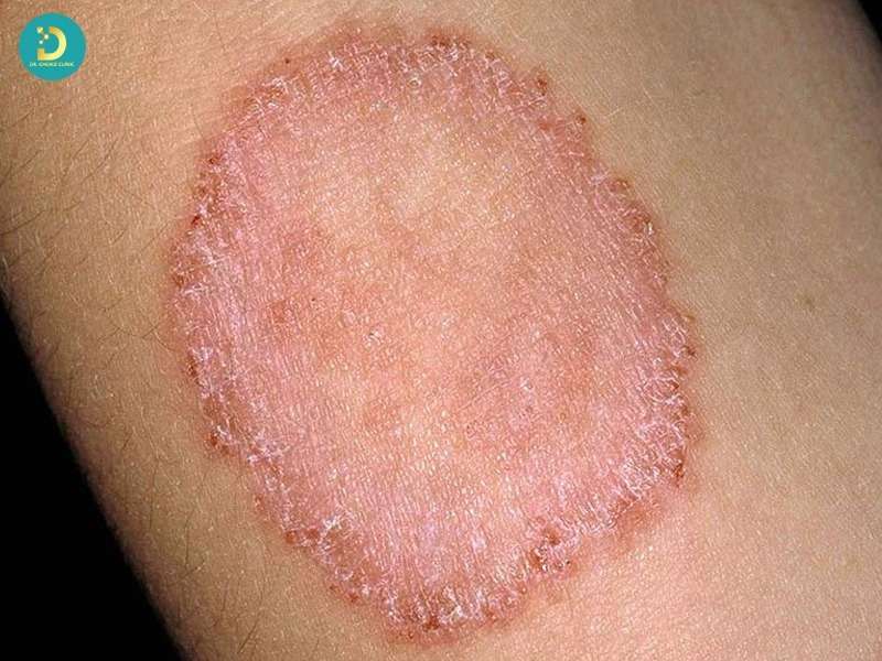 Bệnh nhiễm trùng da do nấm