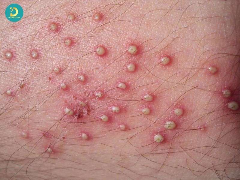 Bệnh nhiễm trùng da do vi khuẩn