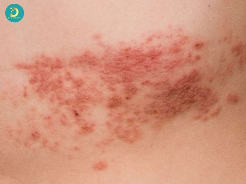 Bệnh nhiễm trùng da do virus