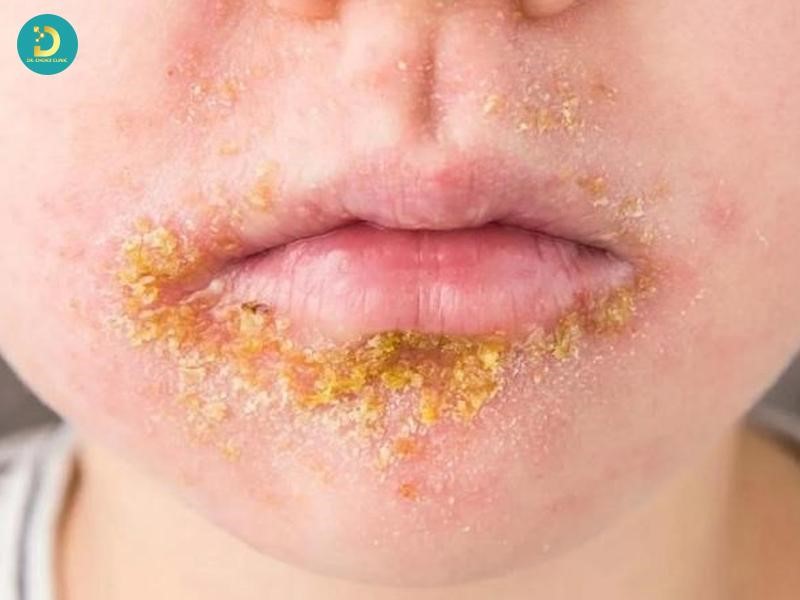 Các Bệnh Ngoài Da Ở Trẻ Em Thường Gặp Và Cách Xử Lý, Phòng Ngừa 15 Nhóm bệnh nhiễm trùng da do vi khuẩn và ký sinh trùng ở trẻ em