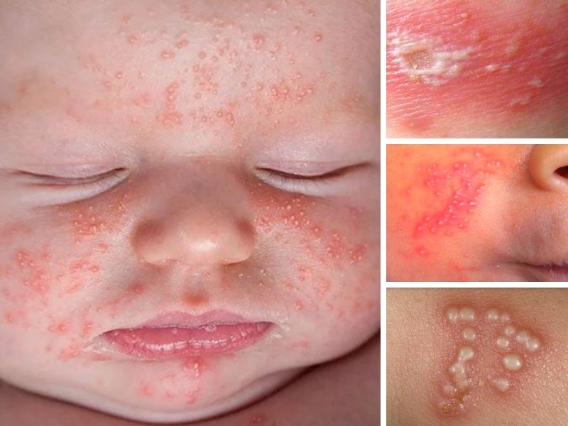Hình ảnh trẻ bị bệnh viêm da mủ
