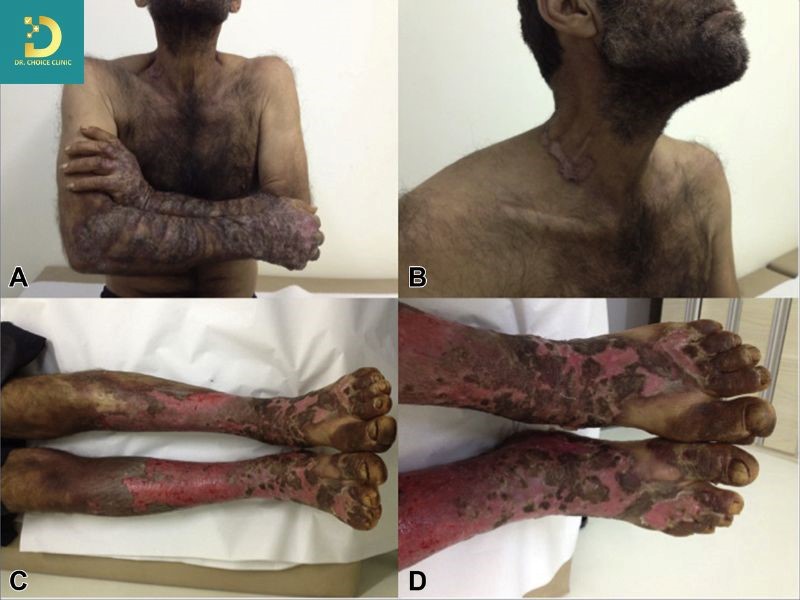 Pellagra: Dấu Hiệu, Nguyên Nhân, Biến Chứng Và Cách Điều Trị, Phòng Ngừa 11 Da là cơ quan chịu ảnh hưởng sớm và rõ nhất của pellagra.