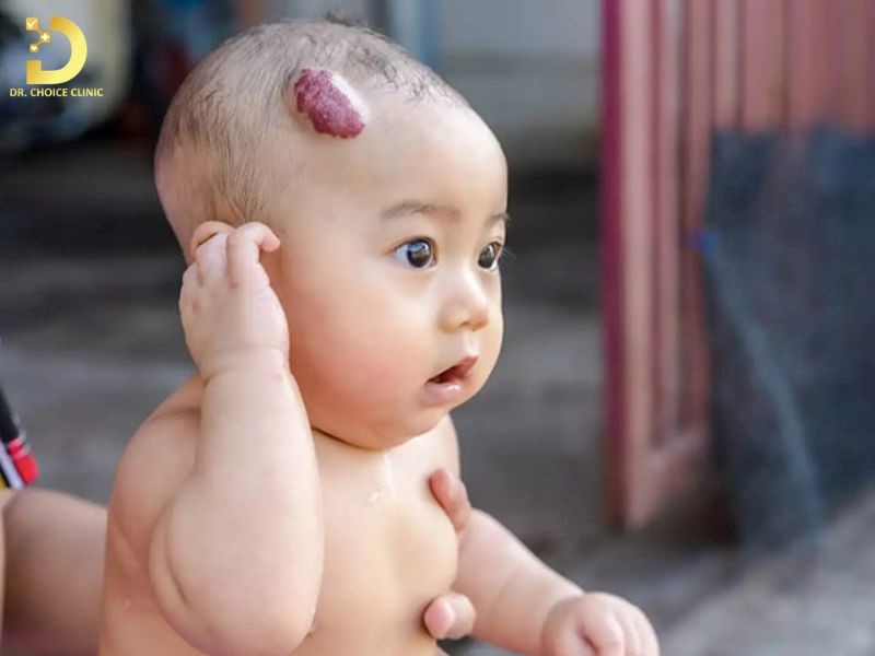 U máu gây ra nhiều biến chứng cho trẻ