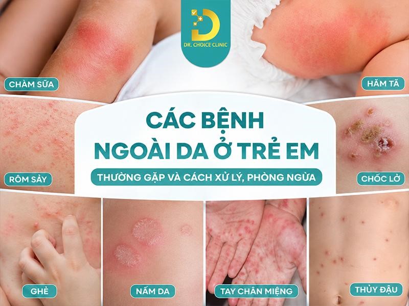 Các Bệnh Ngoài Da Ở Trẻ Em Thường Gặp Và Cách Xử Lý, Phòng Ngừa 13 Các bệnh ngoài da ở trẻ em
