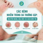 Các bệnh nhiễm trùng da thường gặp