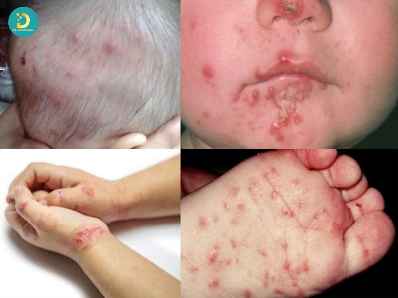 Các vị trí thường bị chốc lở