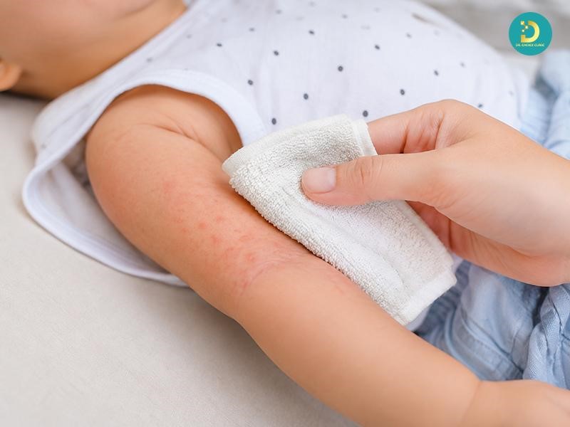 Các Bệnh Ngoài Da Ở Trẻ Em Thường Gặp Và Cách Xử Lý, Phòng Ngừa 20 Giảm ngứa và hạn chế trẻ gãi làm trầy xước da của trẻ