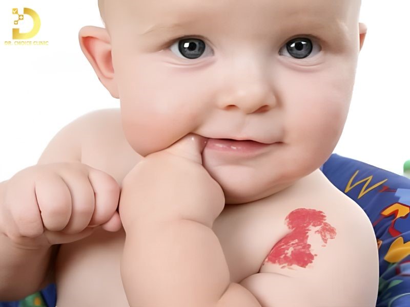 Chăm sóc tại nhà đóng vai trò quan trọng trong quản lý u máu trẻ em