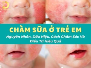Tìm hiểu bệnh chàm sữa ở trẻ em