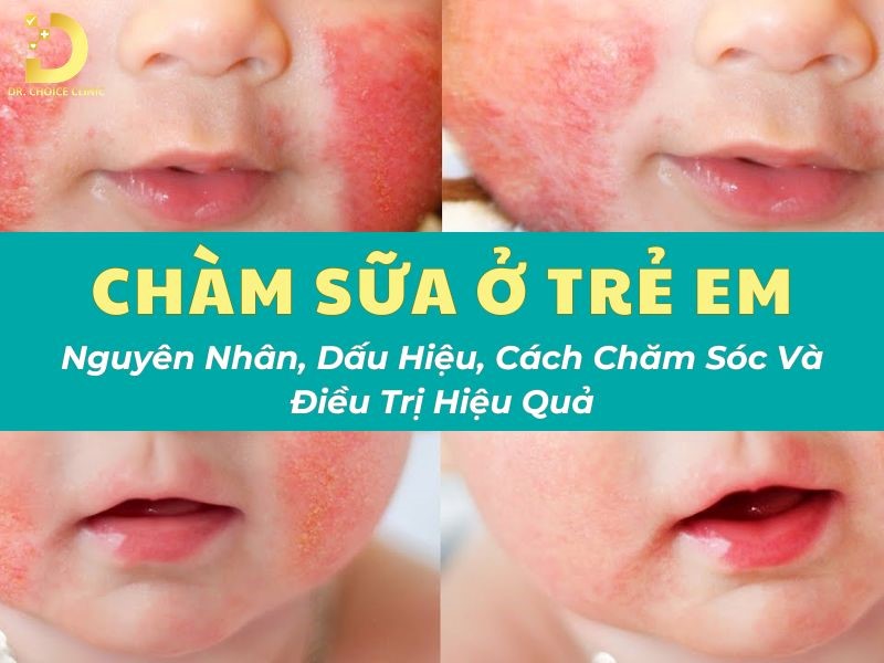 Chàm Sữa Ở Trẻ Em: Nguyên Nhân, Dấu Hiệu, Cách Chăm Sóc Và Điều Trị Hiệu Quả 7 Tìm hiểu bệnh chàm sữa ở trẻ em