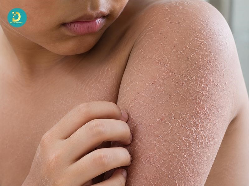 Dấu hiệu nhận biết bệnh vảy cá ở trẻ em