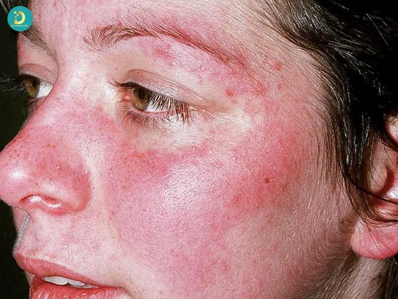 Dấu hiệu nhận biết Lupus ban đỏ hệ thống