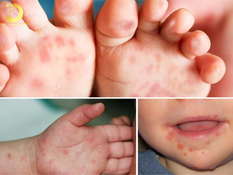 Bệnh Tay Chân Miệng Ở Trẻ: Nguyên Nhân, Dấu Hiệu, Cách Phòng Ngừa Và Điều Trị 11 Dấu hiệu điển hình nhất là các nốt phỏng nước, thường xuất hiện ở lòng bàn tay, lòng bàn chân