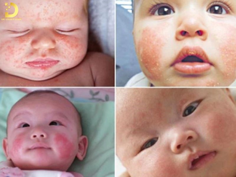 Chàm Sữa Ở Trẻ Em: Nguyên Nhân, Dấu Hiệu, Cách Chăm Sóc Và Điều Trị Hiệu Quả 9 Dấu hiệu nhận biết bệnh chàm sữa ở trẻ