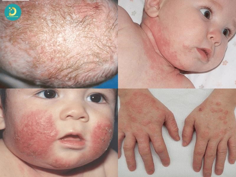 Dấu hiệu viêm da cơ địa trẻ em