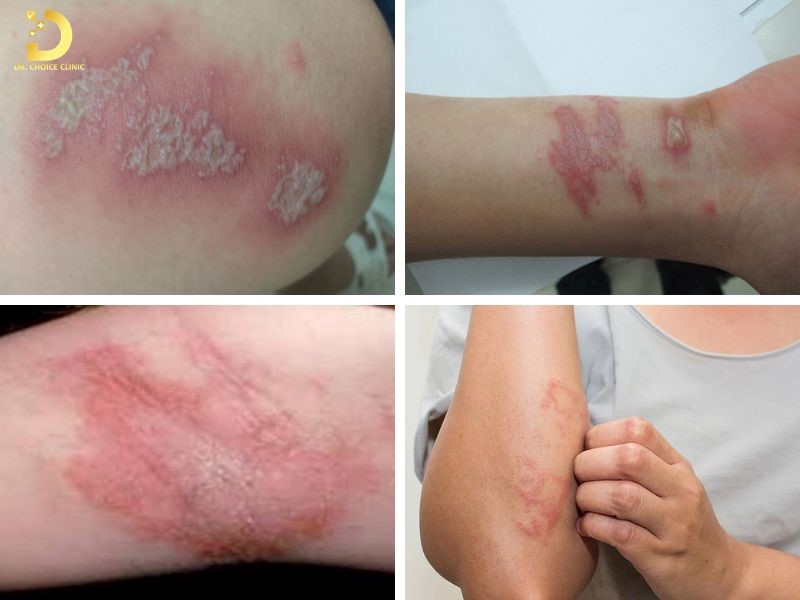 Viêm Da Tiếp Xúc Do Côn Trùng: Triệu Chứng Và Cách Xử Lý Hiệu Quả 10 Tổn thương viêm da tiếp xúc côn trùng thường xuất hiện ở những vùng da hở,
