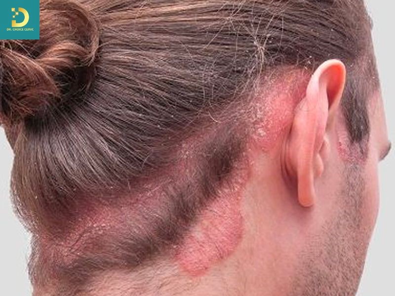 Viêm Da Tiết Bã Nhờn: Nguyên Nhân, Triệu Chứng Và Cách Điều Trị 10 Viêm da tiết bã nhờn phân bố ở vùng da dầu, đây là đặc điểm giúp phân biệt với nhiều bệnh da khác.