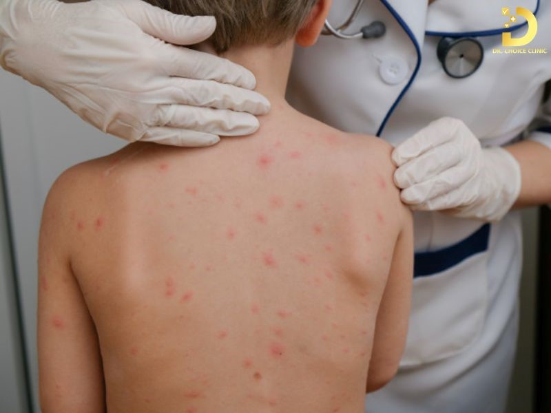 Rôm Sảy: Nguyên Nhân, Triệu Chứng, Cách Điều Trị Và Phòng Ngừa 10 Người bệnh cần đến cơ sở y tế khi rôm sảy không cải thiện sau vài ngày chăm sóc đúng cách