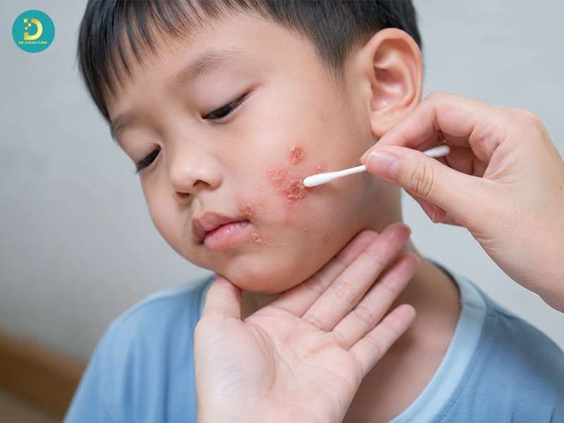 Điều trị chốc lở nhẹ tại nhà như thế nào?