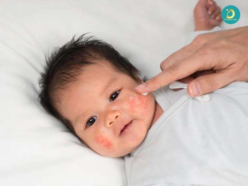 Các Bệnh Ngoài Da Ở Trẻ Em Thường Gặp Và Cách Xử Lý, Phòng Ngừa 19 Dưỡng ẩm và phục hồi hàng rào bảo vệ da cho trẻ