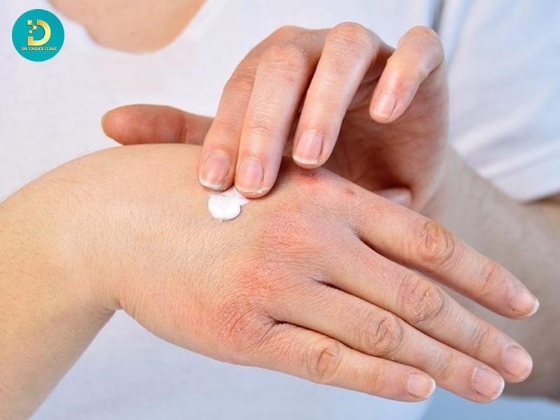 Hướng Dẫn Chăm Sóc Viêm Da Cơ Địa Vào Mùa Hè Hiệu Quả 14 Sử dụng sản phẩm dưỡng ẩm da phù hợp khi viêm da cơ địa