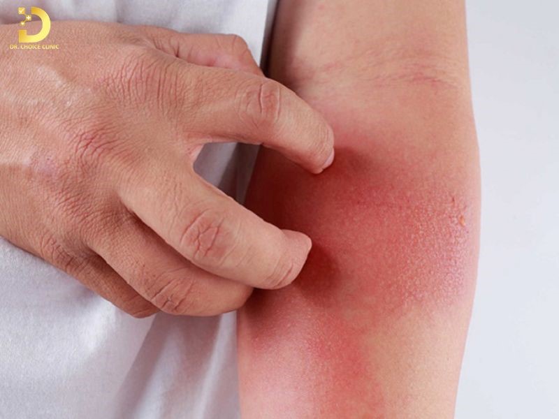 Viêm Da Tiếp Xúc Do Côn Trùng: Triệu Chứng Và Cách Xử Lý Hiệu Quả 12 Không nên gãi khi bị viêm da tiếp xúc côn trùng